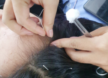 TRỊ LIỆU RỐI LOẠN TIỀN ĐÌNH – GIẢM CHÓNG MẶT, MẤT NGỦ, CĂNG THẲNG