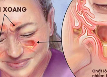 ĐIỀU TRỊ VIÊM XOANG MÃN TÍNH THEO PHƯƠNG PHÁP Y HỌC VIỆT & PHẢN CHIẾU VI CƠ THỂ